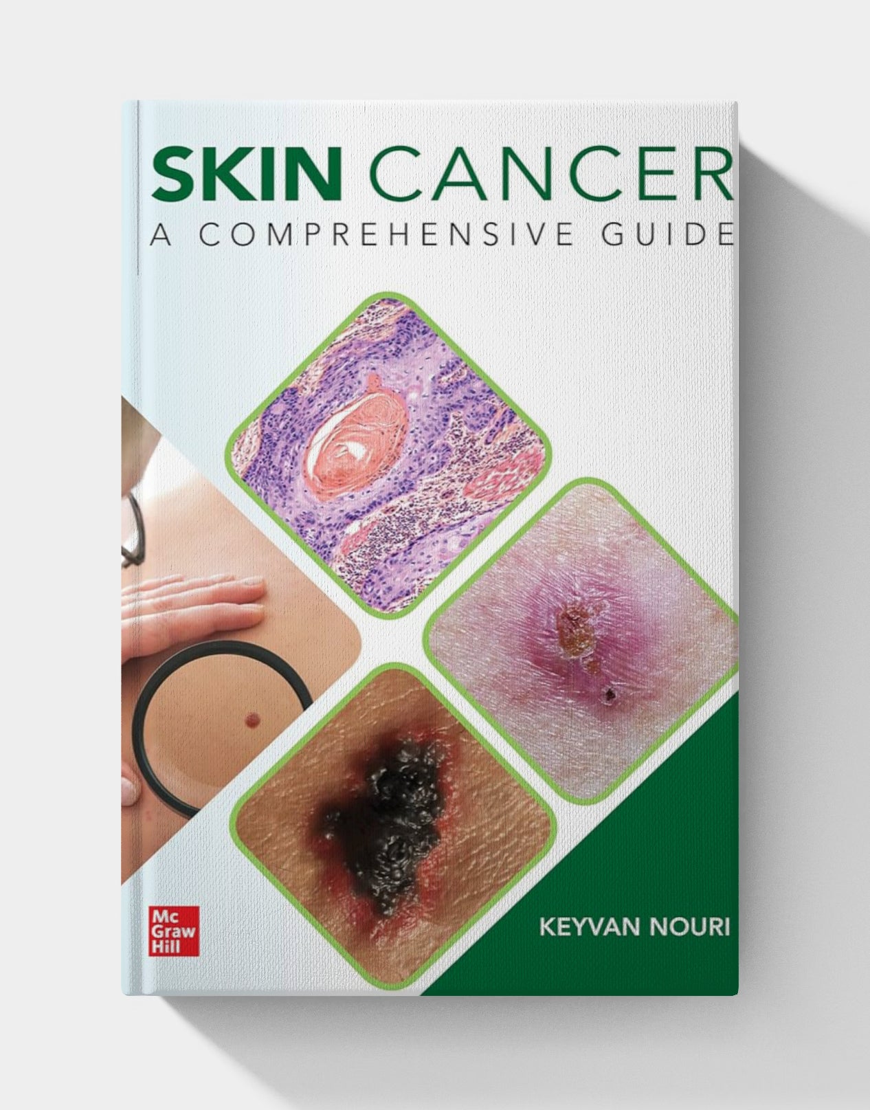 Skin Cancer: A Comprehensive Guide